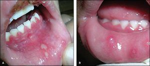 herpetic-gingivostomatitis-600x266