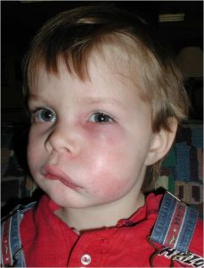 abscess-facialswelling-kid