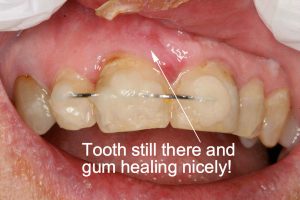 avulsion-subluxation-3-1280x850