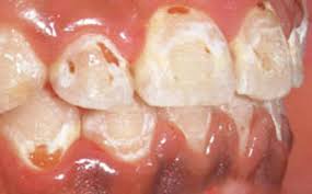 damage-from-bad-oral-hygiene-around-braces-510-x-317