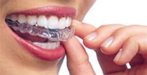 retainer-placement